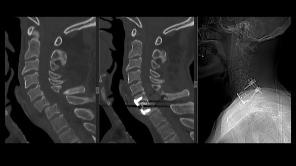 Lussazione Cervicale Traumatica C6-C7 (approccio anteriore+posteriore).jpg