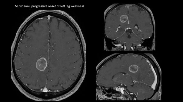 glioblastoma