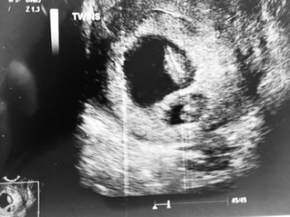 The Empty Crib: My Story with Vanishing Twin Syndrome