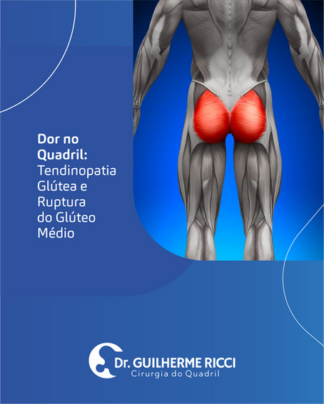 Dor no Quadril: Tendinopatia glútea e ruptura do glúteo médio