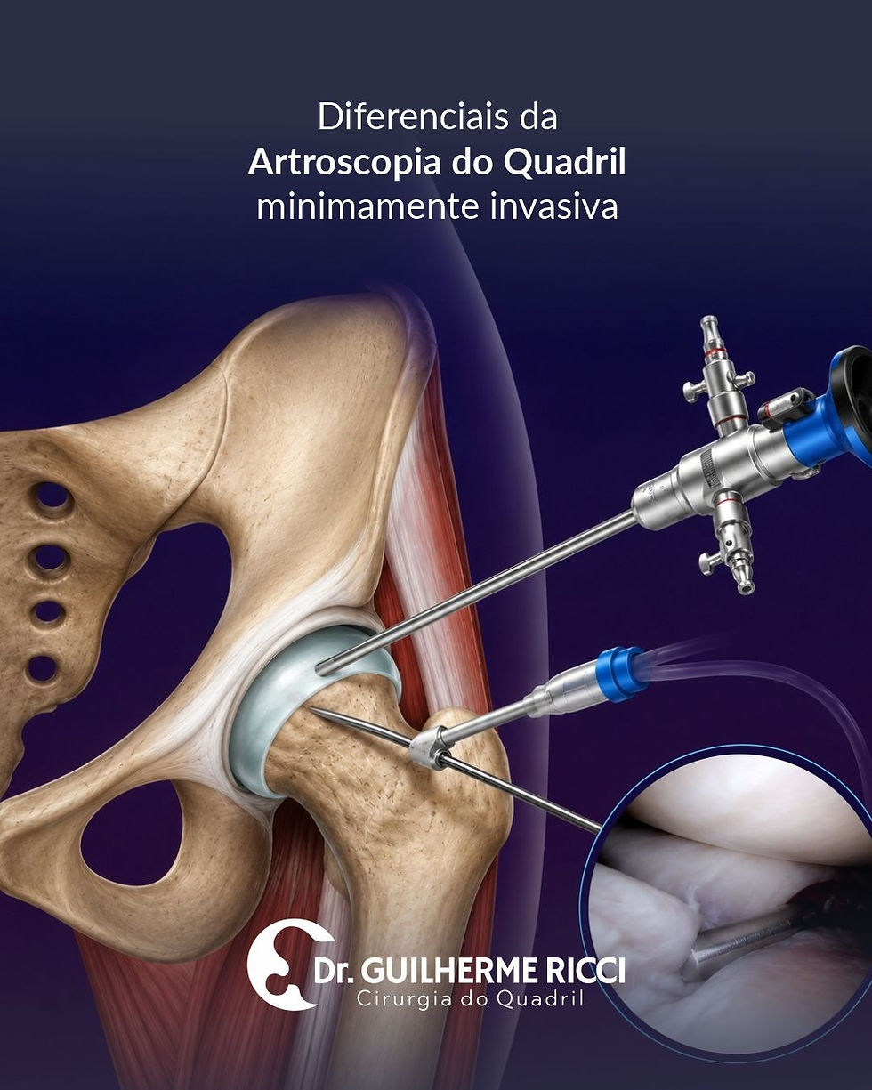Diferenciais da Artroscopia do Quadril Minimamente Invasiva