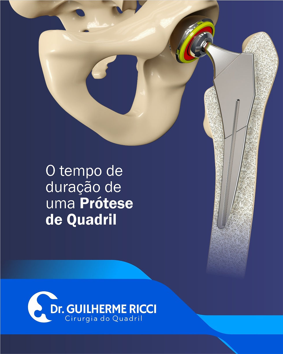 Tempo de duração de uma Prótese de Quadril