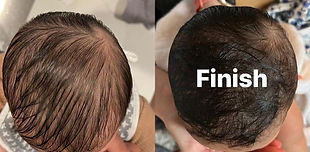 plagiocephaly comparison before and after