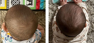 plagiocephaly comparison before and after