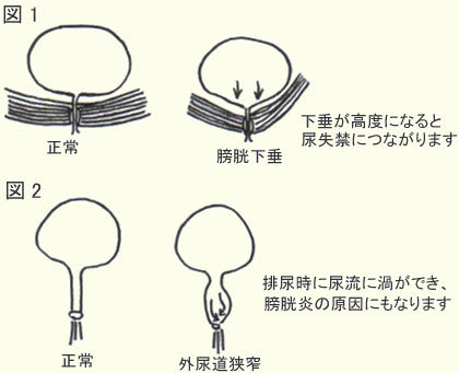 中高年女性の膀胱炎症状.jpg