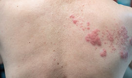 Canva - Shingles (Disease), Herpes zoste