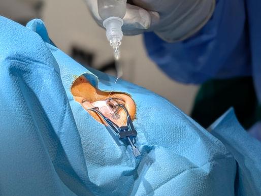 Chirurgie réfractive à Antibes – correction laser des yeux (LASIK, myopie, astigmatisme)