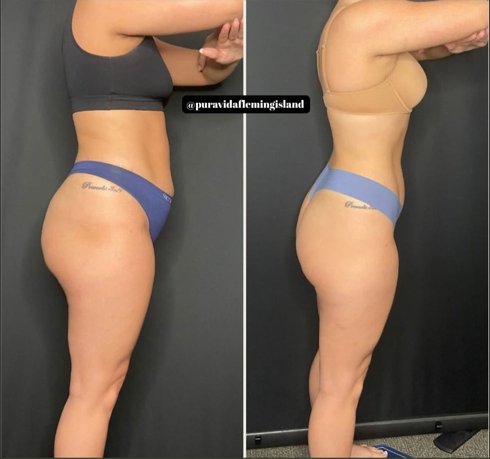 before and after weight loss tummy