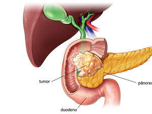 Quais as doenças do pâncreas?