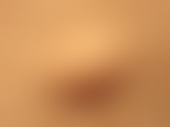 Lesões benignas da pele - lipoma