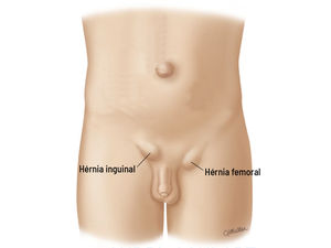 O que é uma hérnia femoral?