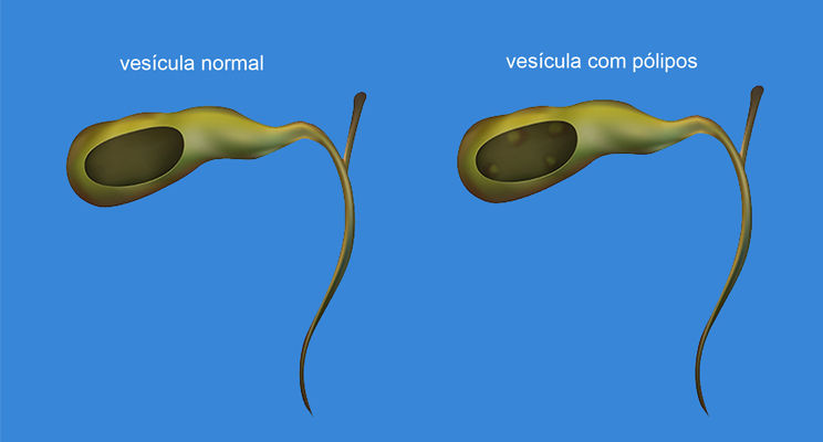 O que são pólipos da vesícula?
