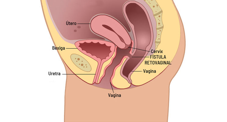 ree