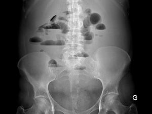 Diagnóstico e tratamento das bridas intestinais?