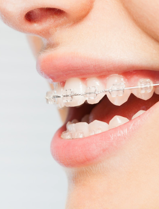 Woman With Braces.png