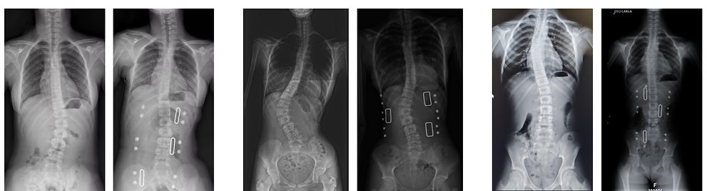 casos clinicios ortoteses de tronco colete ortopédico escoliosehipercifose mgortopedia porto lisboa angola correção porto lisboa angola mg ortopedia