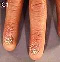 Photo of nail abnormalities