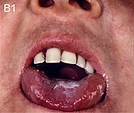 Photo of leukoplakia