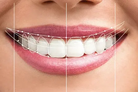hollywood-smile.webp