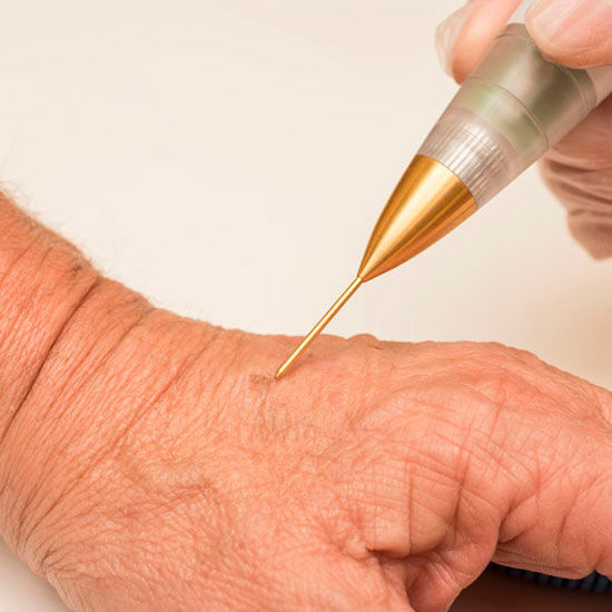 Jato de Plasma Corporal