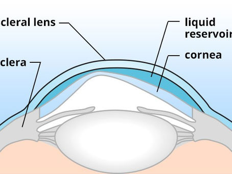 Are Scleral Lenses Comfortable?