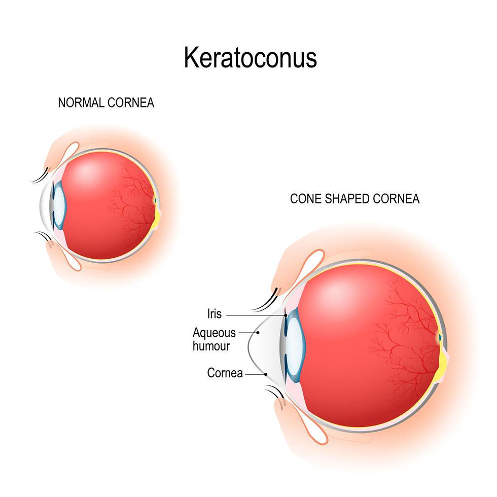 Can Scleral Lenses Help Keratoconus?