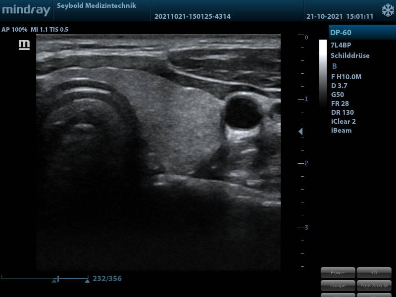 Miniaturbild: Ultraschallbild Schilddrüse Ultraschallgerät DP-50 von mindray