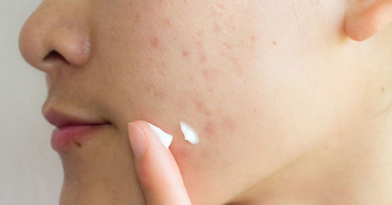 Acne-Scar-Treatments.jpg