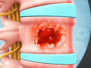New Research #8 : Cryoablation for Bone Cancer