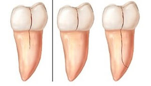 cracked tooth.jpg