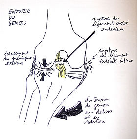 Rupture du ligament croisé antérieur (LCA) | Dr Dani Massie Chirurgien Orthopédique Montréal Rupture du ligament croisé antérieur (LCA) | Dr Dani Massie Chirurgien Orthopédique Montréal