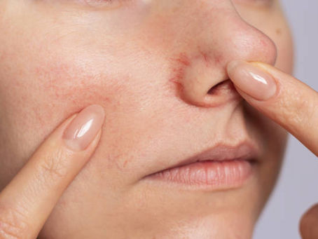 Effective Remedies for Broken Capillaries: How High Frequency and Lasers Can Help
