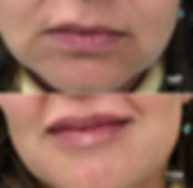 טיפולי בוטוקס