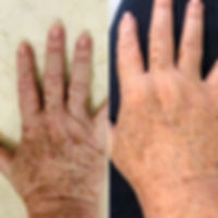 בוטוקס ידיים