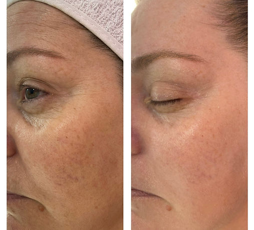 ANTES E DEPOIS SENHORA BOTOX RUGAS SERUM EFEITO BOTOX SKINCARE