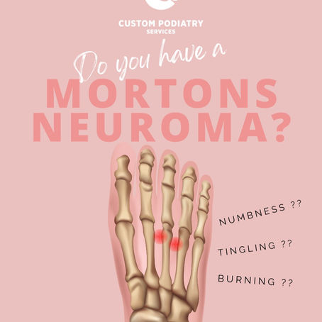 Mortons Neuroma?