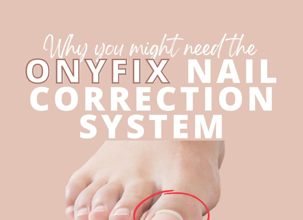 Onyfix Nail Correction System