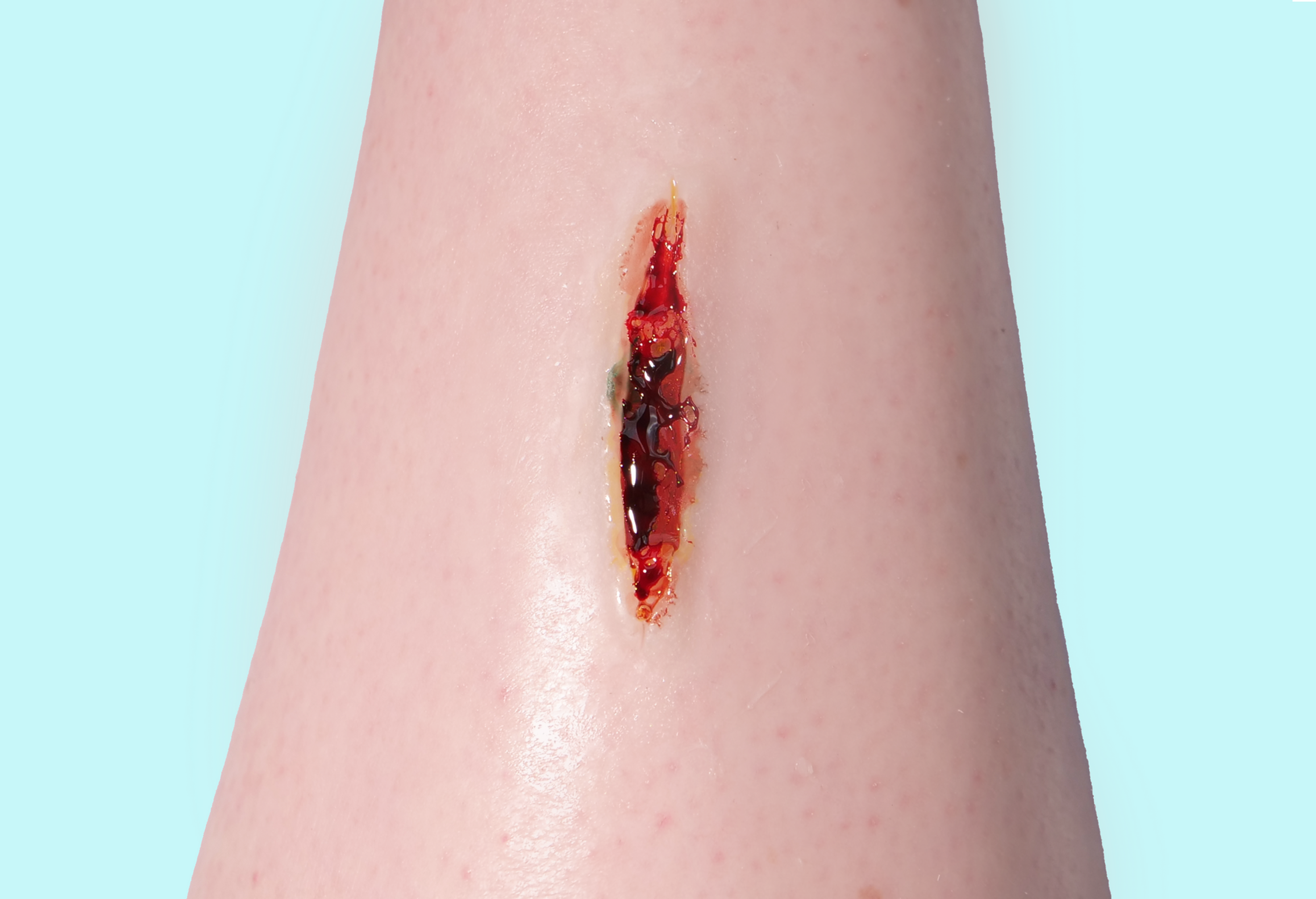 Deep Laceration Prosthetics