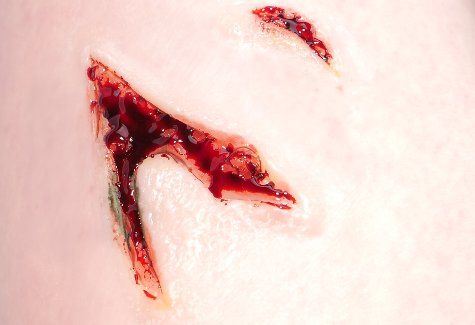 Thumbnail: Deep Laceration Prosthetics