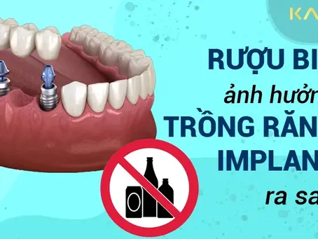 Rượu bia ảnh hưởng đến trồng răng Implant ra sao?