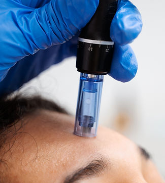 Séance de microneedling du visage pour améliorer le teint et stimuler le collagène lyon 3