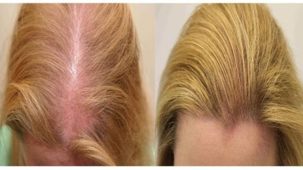 Hair Loss / Acne | alternative-therapy Hair Loss / Acne | alternative-therapy