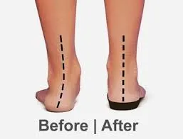 Before and after Orthotic Insoles