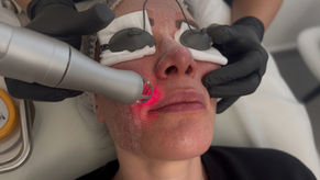 Professional CO2 laser skin rejuvenation treatment being performed at a medical aesthetics clinic to improve skin texture and wrinkles.