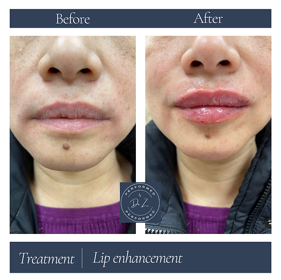 Lip filler1-B (2).png