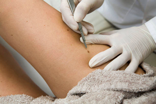 Read about skin surgery options for benign growths.