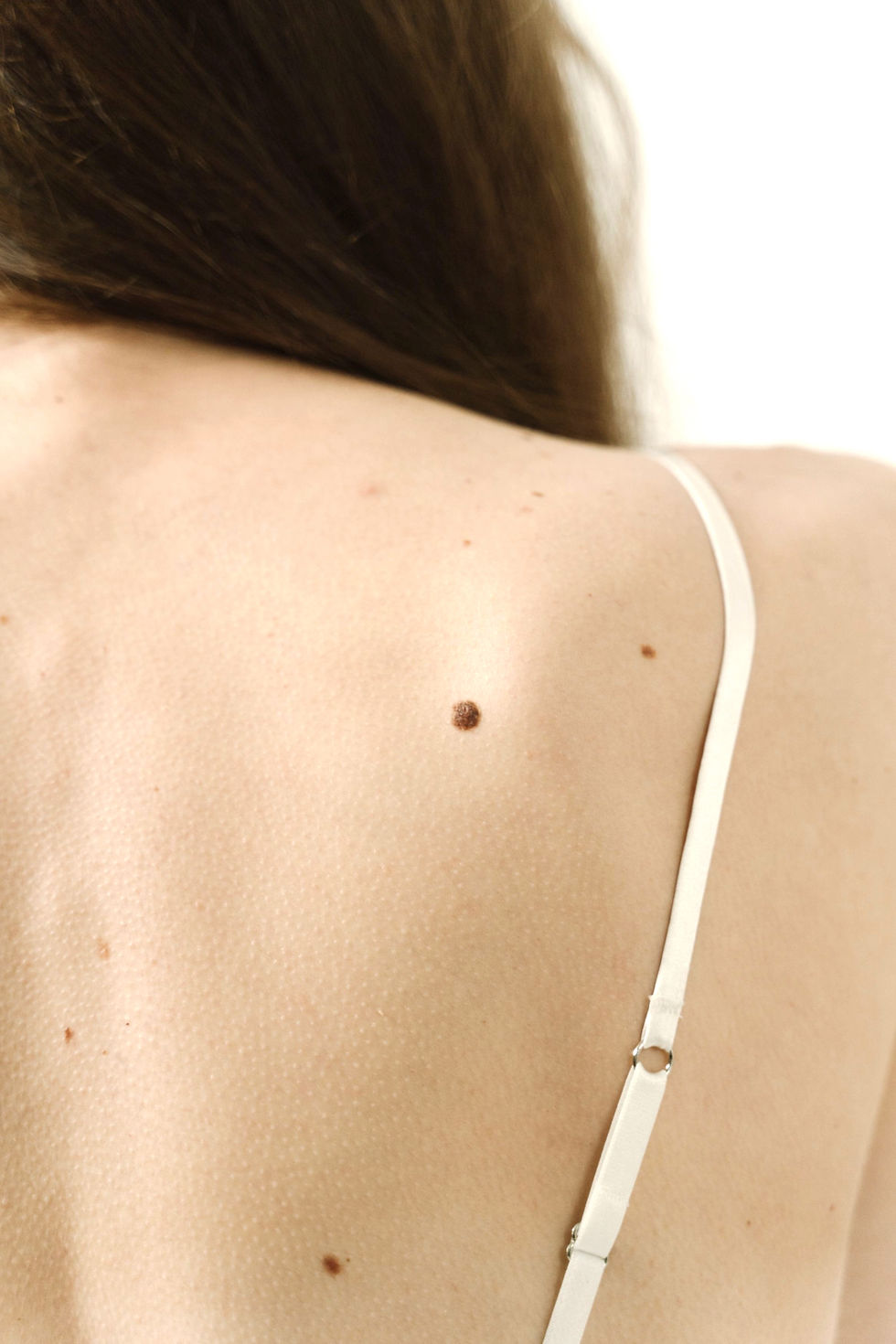 Moles & Unwanted Lesions Information Page