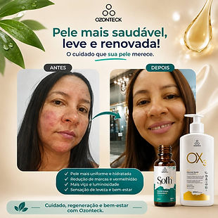 Antes e depois de cuidado facial com produtos Ozonteck