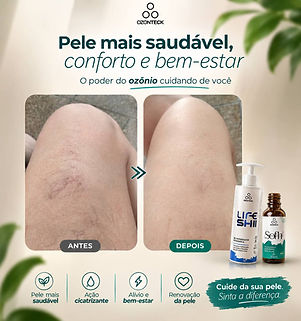 Antes e depois de cuidado corporal com Life Shii e Sofh Ozonteck