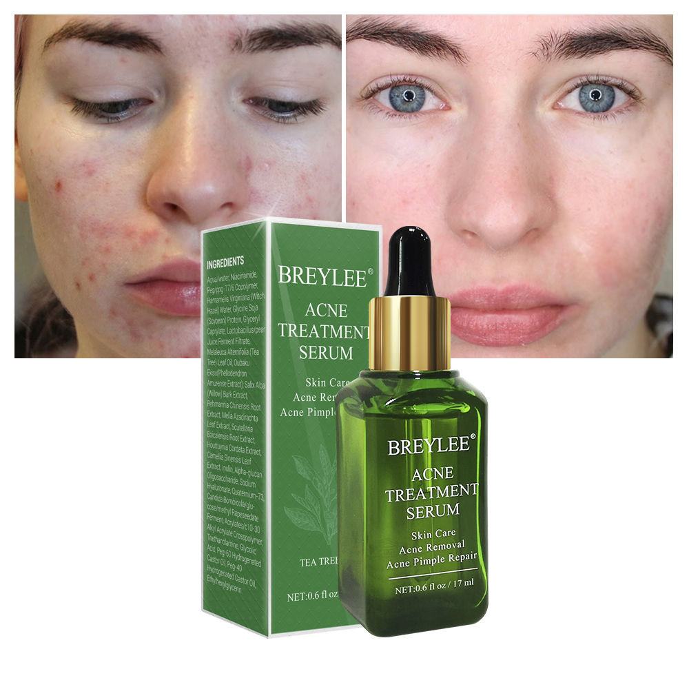 BREYLEE Tea Tree Acne Spot Treatment Serum – Natural Skin Care